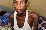 Samba Yoro, amputé de la jambe et gravement malade, lutte pour sa vie dans l’indifférence (photo)