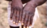 1er cas de Mpox importé au Sénégal : transmission, symptômes et mesures de prévention, ce qu’il faut savoir sur (…)